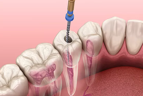 root canal