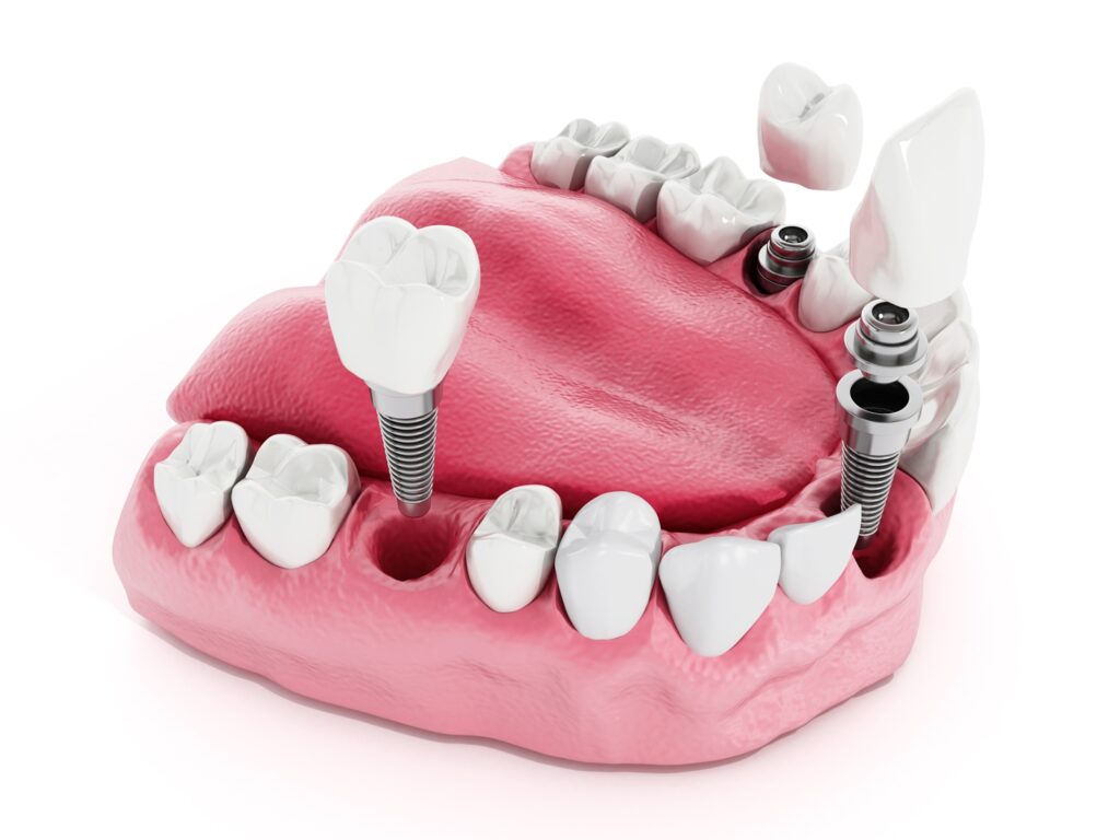 Dental implant detail