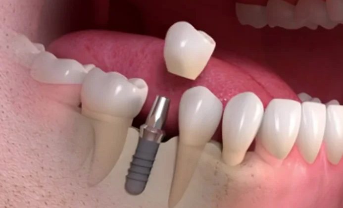 dental implant new