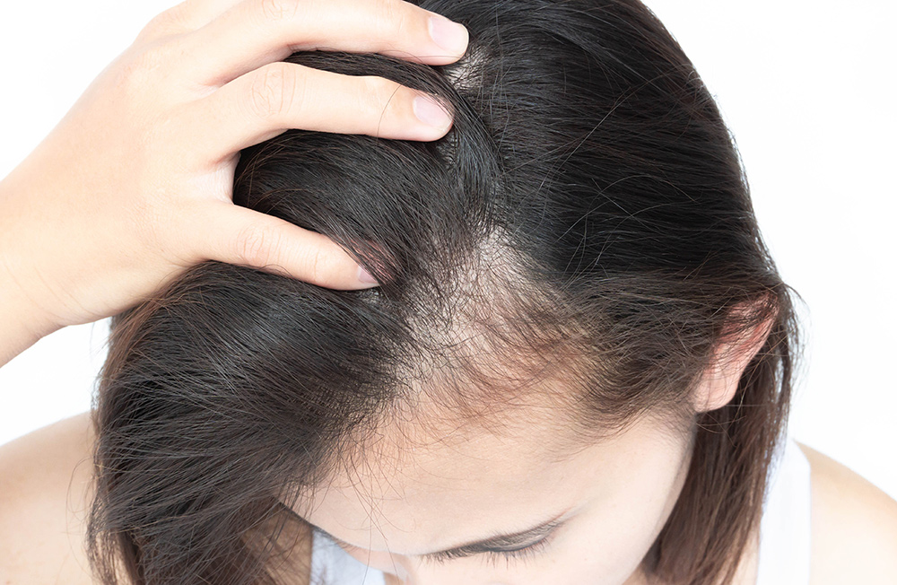 Woman serious hair loss problem for health care shampoo and beau