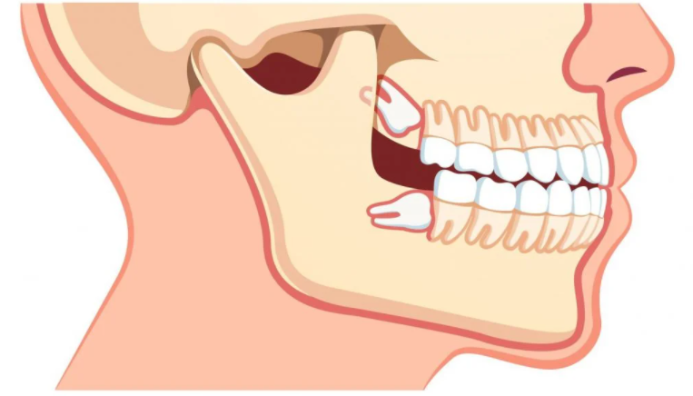 are-teeth-classified-as-bones