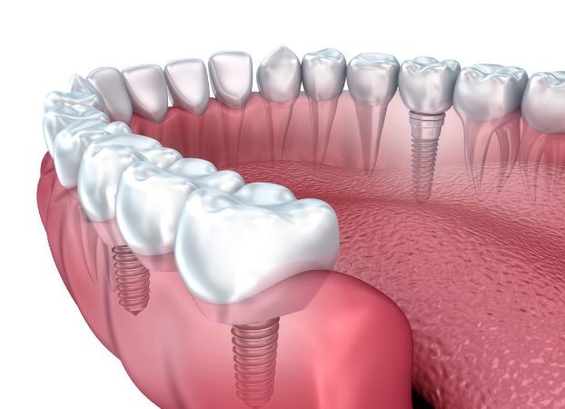 Benefits of dental implant